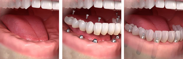 fija-sobre-implantes-clinica-dental