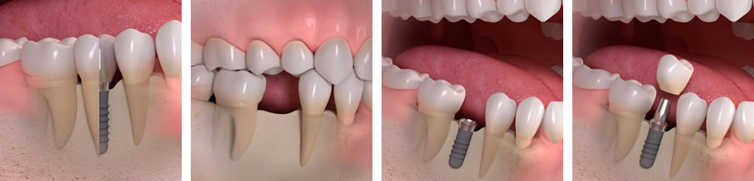 implantes-unitarios-clinica-dental